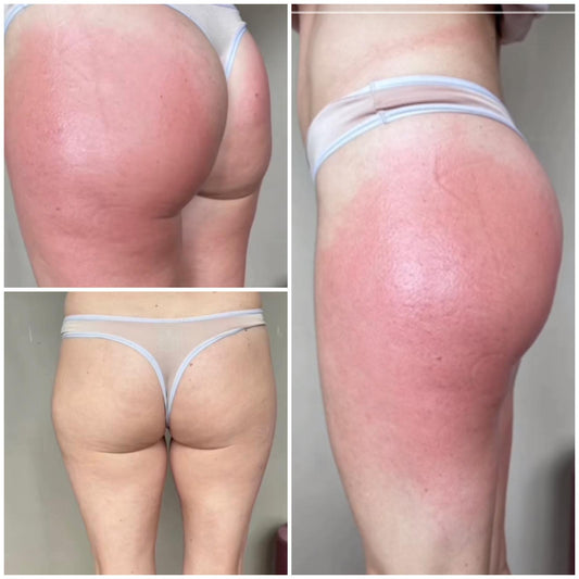 Dispositivo manuale a coppettazione- Body365